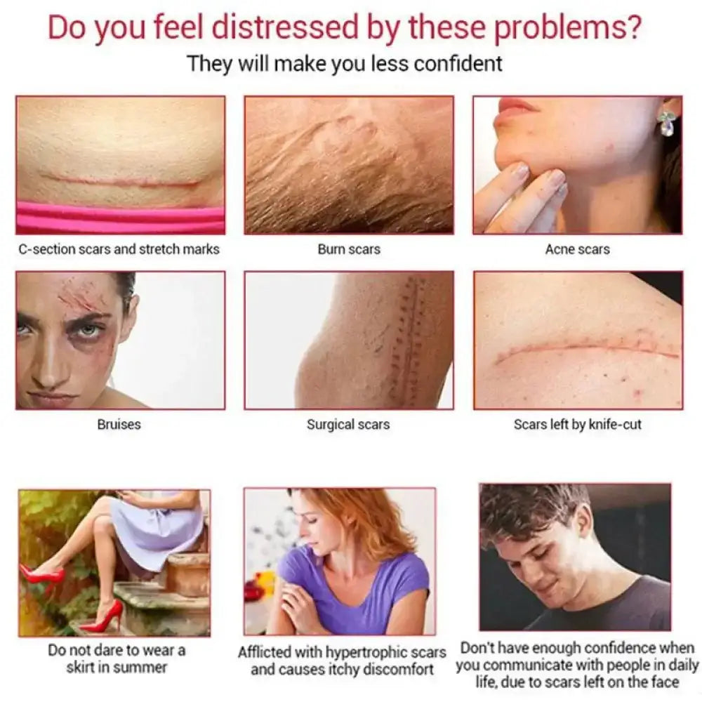 Youthful Scar Remover Cream 2.0 – Natural Scar Treatment 30ml