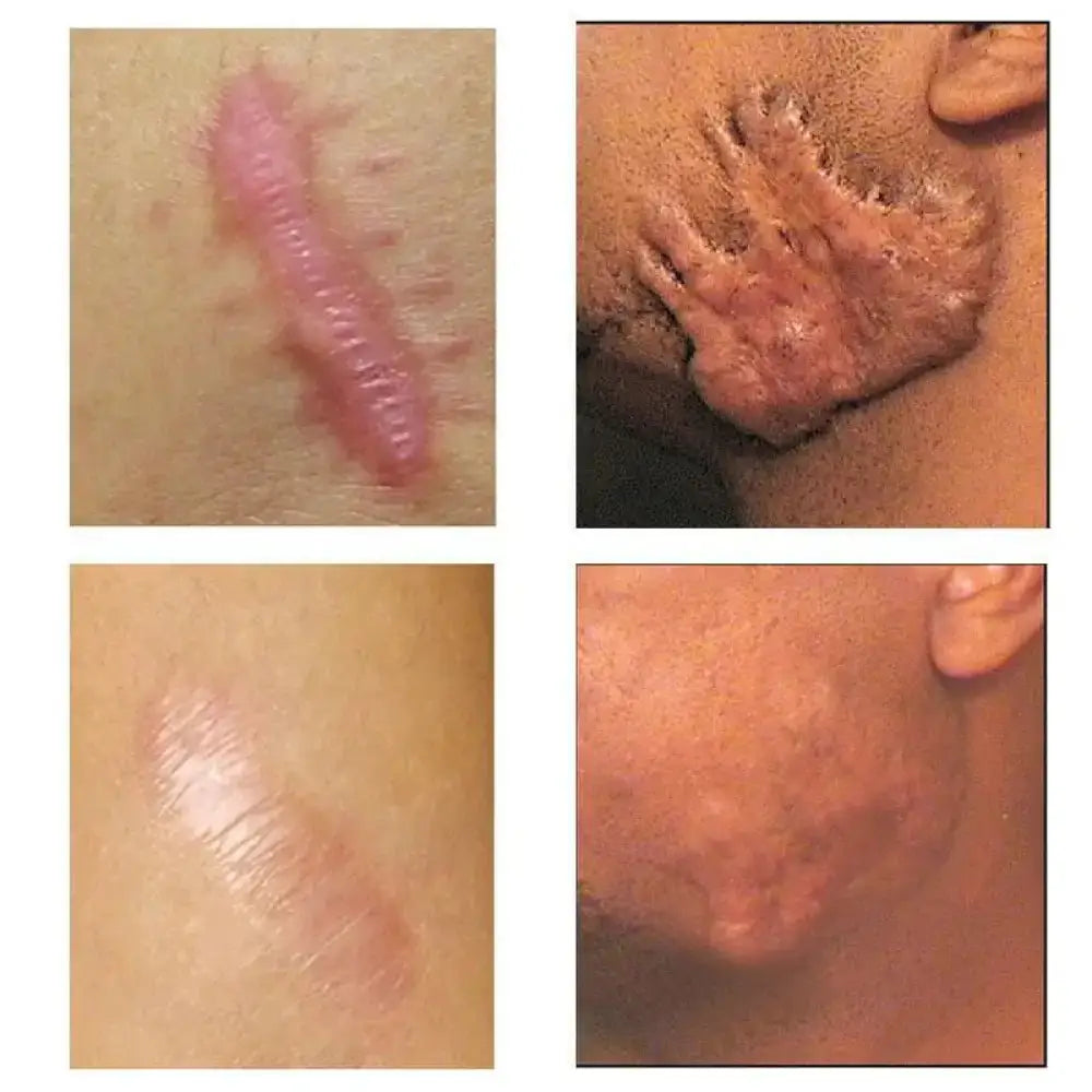 Youthful Scar Remover Cream 2.0 – Natural Scar Treatment 30ml